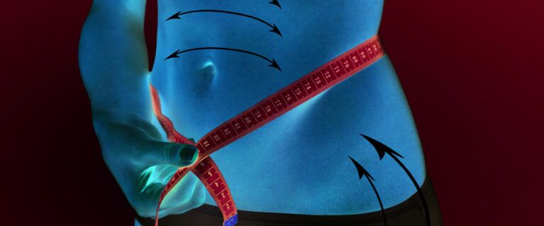 Reduction of subcutaneous fat in the abdomen and sides as a result of weight loss in one week.
